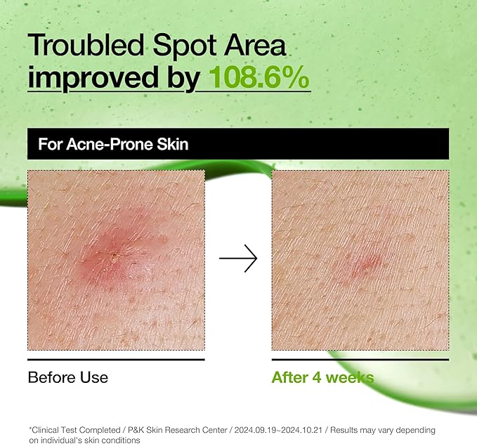 Anua Suero Facial Calmante con Acido Azelaico 10% y Acido Hialuronico, para Piel Sensible