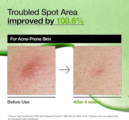 Anua Suero Facial Calmante con Acido Azelaico 10% y Acido Hialuronico, para Piel Sensible